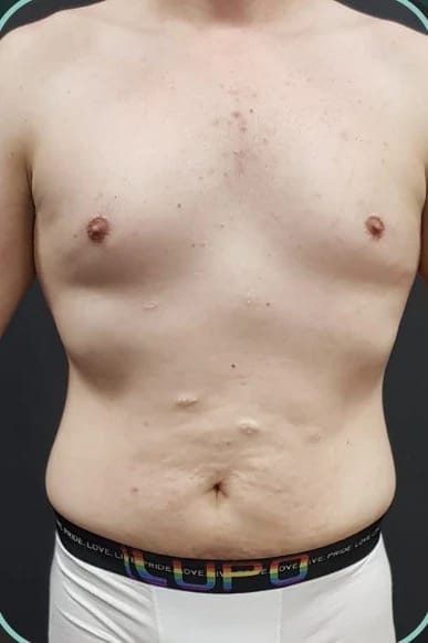 Antes, Lipoabdominoplastia masculina — antes e depois, paciente Union