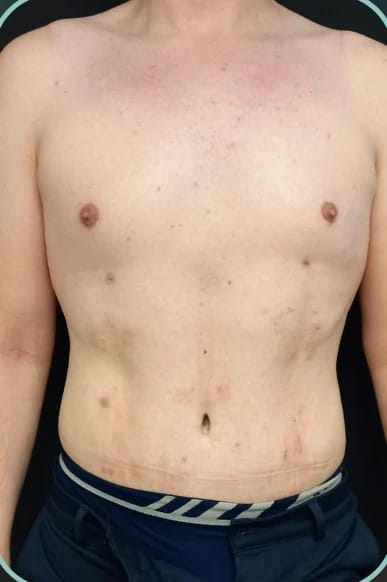 Depois, Lipoabdominoplastia masculina — antes e depois, paciente Union
