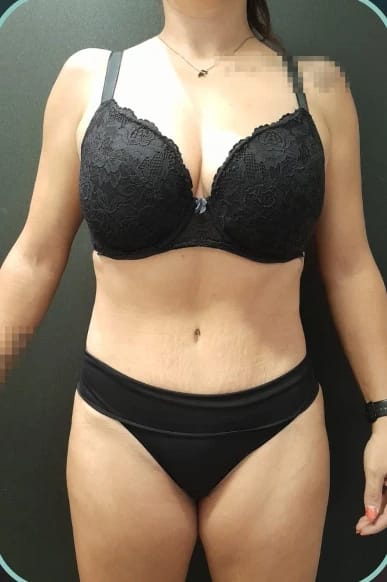 Depois, Lipoabdominoplastia — antes e depois, paciente Union