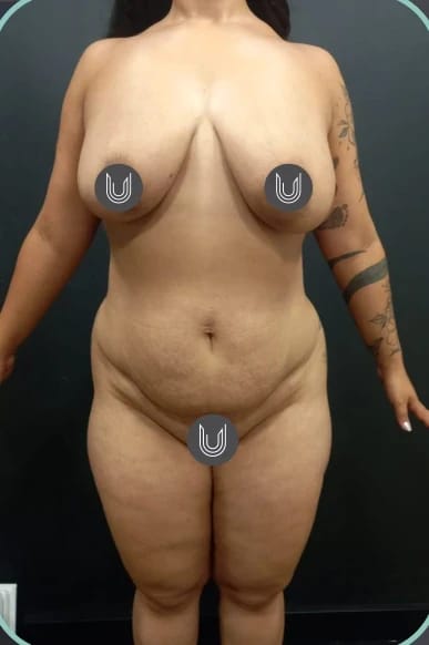 Antes, Lipoabdominoplastia — antes e depois, paciente Union