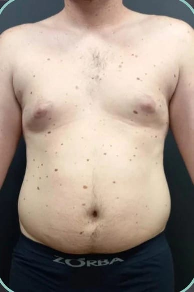 Antes, Lipoescultura HD masculina — antes e depois, paciente Union