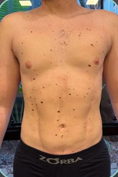 Depois, Lipoescultura HD masculina — antes e depois, paciente Union